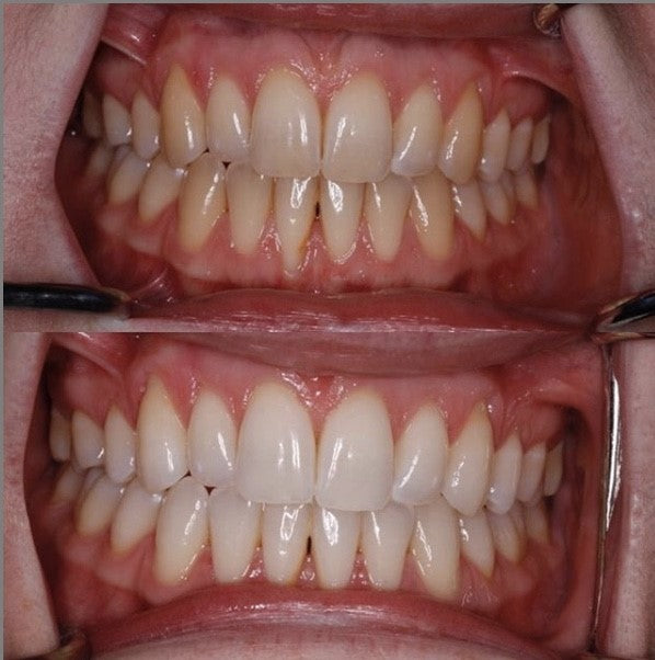 POLA Light 9.5% Hydrogen Peroxide - Led Advanced Teeth Whitening System