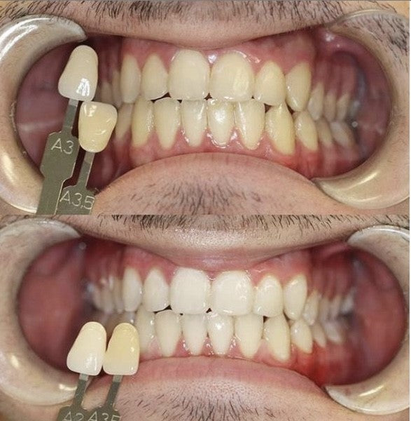 POLA Light 9.5% Hydrogen Peroxide - Led Advanced Teeth Whitening System